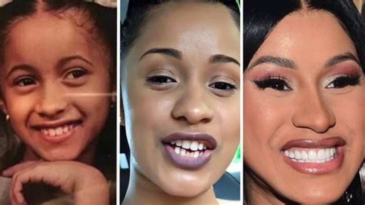 Did Cardi B Have Braces Or Invisalign Cardi B's Dental Work Secrets