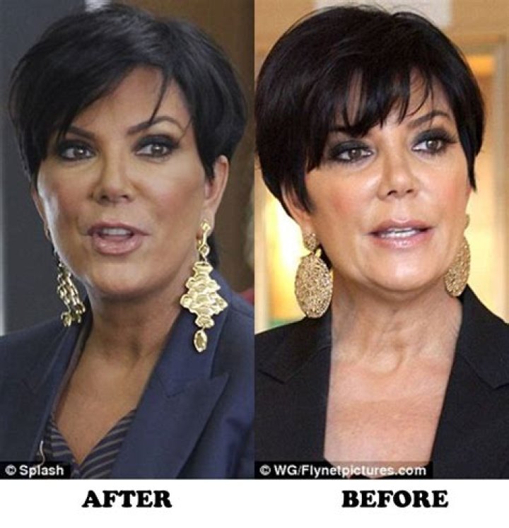 Kris Jenner Plastic Surgery Before And After Pictures vrogue.co